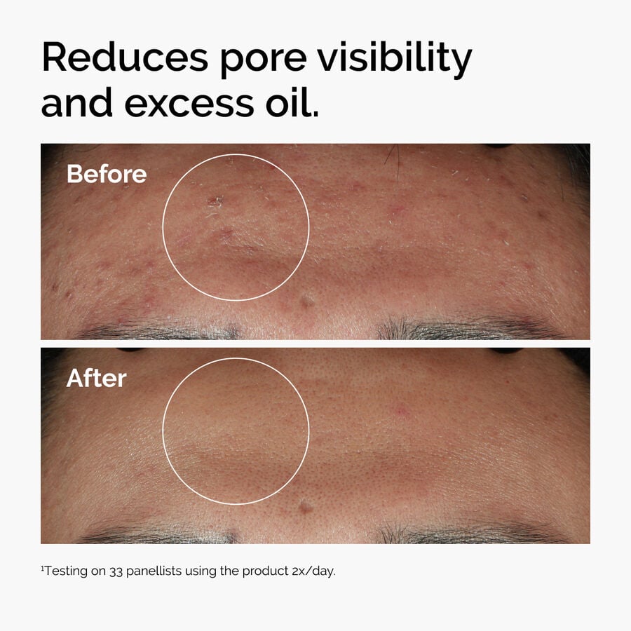 niacinamide-10-zinc-1-c1 ord-niacinamide-zinc-blemish-serum-before-after-pores.jpg