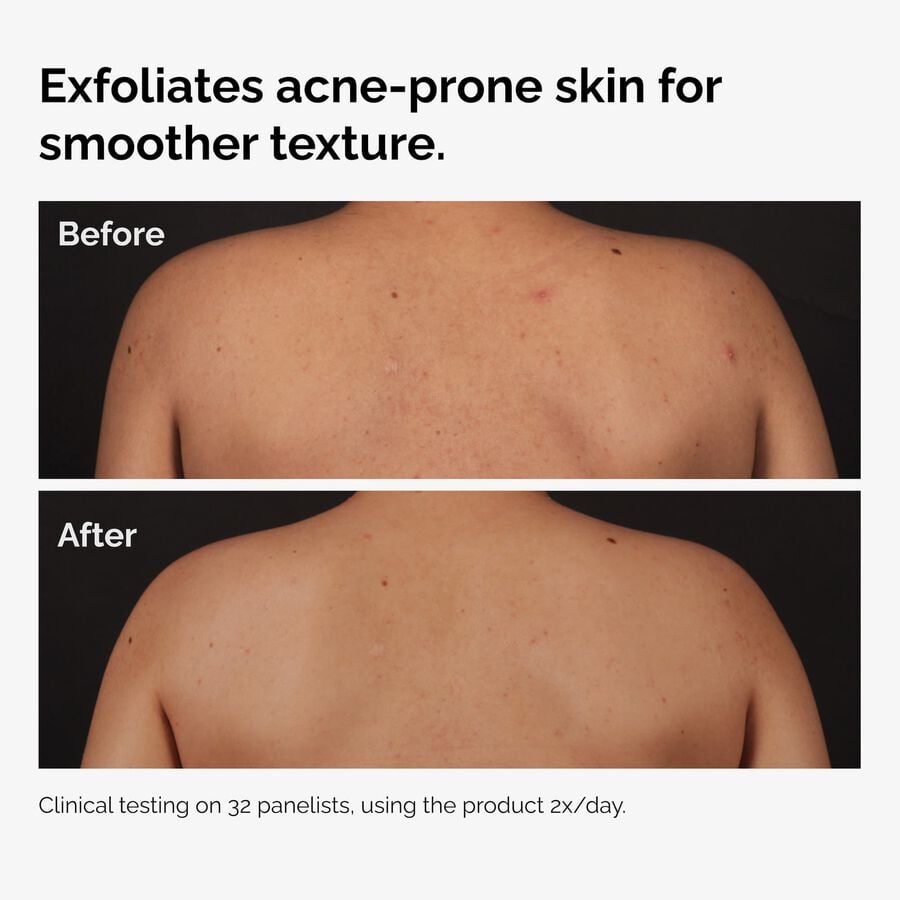 the-body-care-collection-b4 ord-salicylic-acid-body-serum-before-after-graphic-NA.jpg
